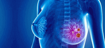 best hospital for breast cancer treatment in bangalore